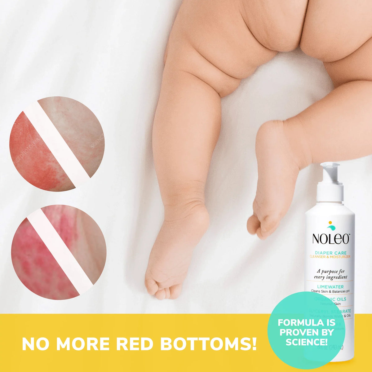 for Butt DUO NOLEO Treatment Rash Rash Diaper -